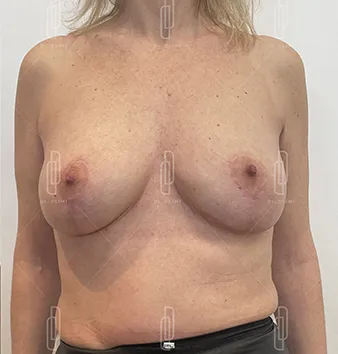patiente après intervention de lifting des seins